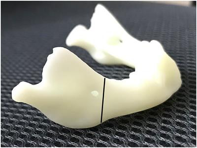 Treated Pierre Robin Sequence Using Placed Allogenic Acellular Bone Matrix and Mandibular Distraction Osteogenesis in the Neonate